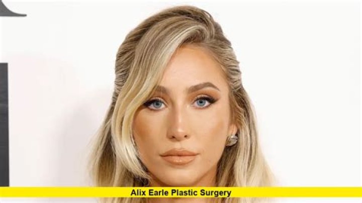 Did Alix Earle Undergo Plastic Surgery?